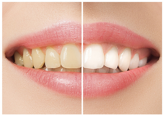 Teeth Whitening | Beyond Dental Health